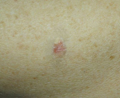 Carcinoma basocelular