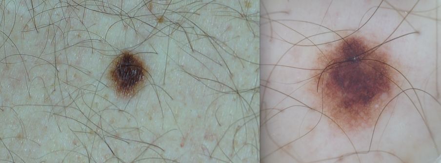 Nevo visto a olho nú (esquerda) e com o dermatoscópio (direita)