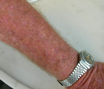 Múltiplas queratoses actínicas no antebraço e mãos-campo de cancerização