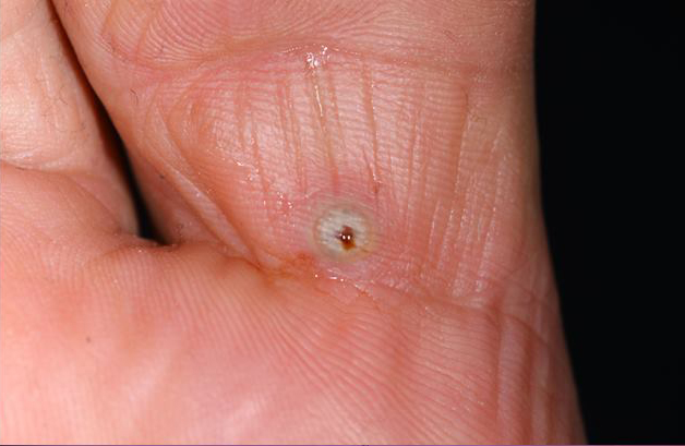 tungiase-dermatologia-e-saude (2)