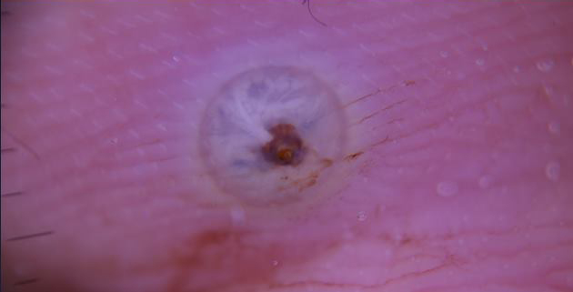 tungiase-dermatologia-e-saude (3)