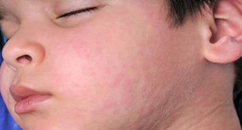 urticaria-dermatologia-e-saude