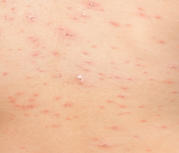 varicela-dermatologia-e-saude-350x300-02
