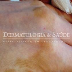 Vitiligo generalizado