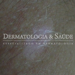 Vitiligo localizado