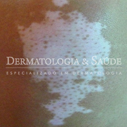 Vitiligo