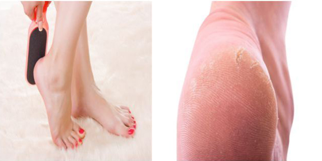 Espessamento de calcanhar com rachaduras. Não se aconselha lixar