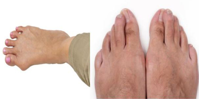 Hálux valgo conhecido como joanete