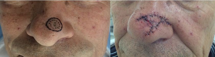 Resultado pós cirurgia micrográfica de Mohs com dois estágios no nariz 
