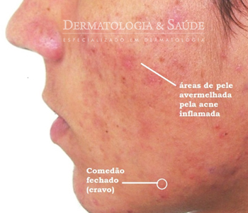 A isotretinoína é atualmente o medicamentos de escolha em casos mais intensos de acne. Para casos leves, como este, apenas medicamentos tópicos podem ser suficientes