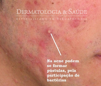 A isotretinoína mesmo tópica pode melhora lesões de acne leve