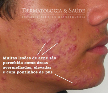 O tratamento com isotretinoína produz grande melhora na acne, porém deve ter seguimento rigoroso pelo dermatologista