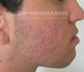 Riscos da isotretinoína riscos-isotretinoina-dermatologia-e-saude-350x300-5