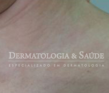 sifilis-dermatologia-e-saude-350x300-3