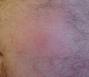 gnatostomiase-dermatologia-e-saude-350x300-1