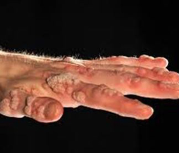 Grande quantidade de verrugas virais (HPV) na mão de pessoa com imunidade comprometida