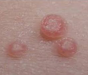 molusco-contagioso-dermatologia-e-saude-350x300-1