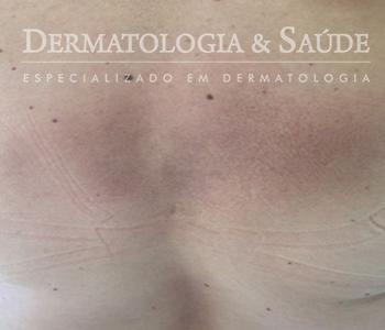 Aspecto manchado e escoriado no dorso de paciente feminino