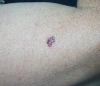 o-que-e-cancer-de-pele-e-seus-tipos-dermatologia-e-saude-350x300-1