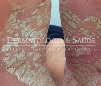 psoriase-dermatologia-e-saude-350x300-6