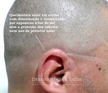Sempre esquecidas na hora de usar o foto protetor, as orelhas frequentemente se queimam, principalmente quando se raspa os cabelos