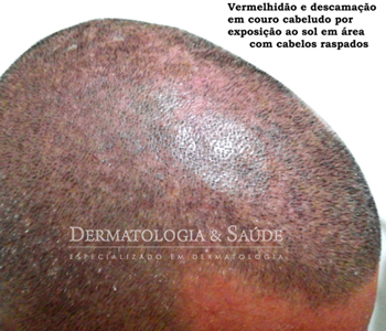 O couro cabeludo é protegido pelos cabelos, e suscetível a queimaduras na exposição após raspagem dos fios ou calvície ( alopecia androgenética)