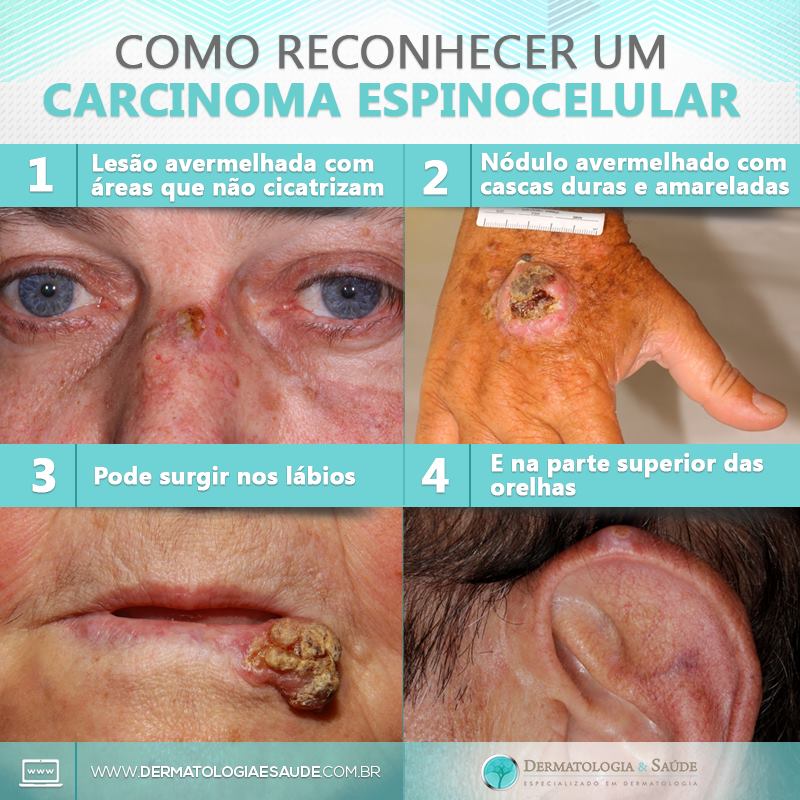 como-reconhecer-um-carcinoma-espinocelular-dermatologia-e-saude-01