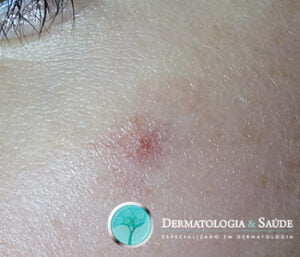 Aranha-vascular-dermatologia-e-saude-02