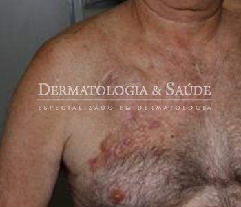 Dermatofibrosarcoma-Protuberans-dermatologia-e-saude-350x300