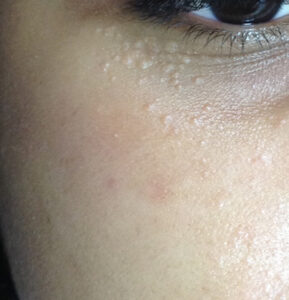 Siringoma-dermatologiae-e-saude