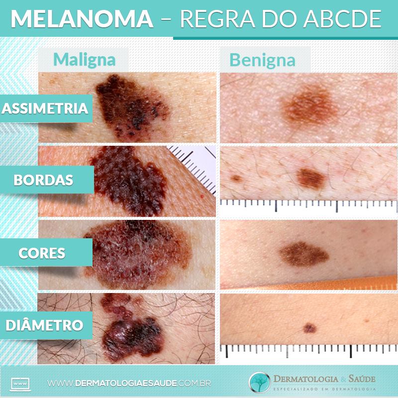 melanoma-regra-do-abcde-dermatologia-e-saude