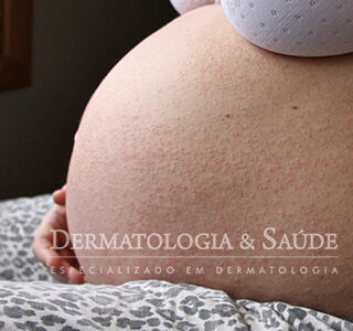 Dermatologia na amamentação