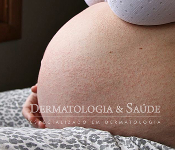 Erupção polimórfica da gravidez erupcao-polimorfica-da-gravidez-dermatologia-e-saude-1