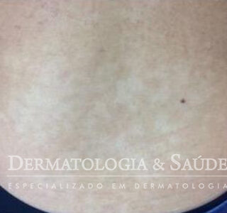 Hipomelanose macular idiopática com manchas claras no tronco