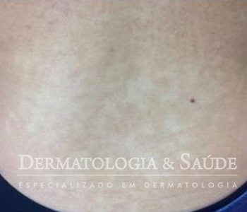 Hipomelanose macular idiopática com manchas claras no tronco
