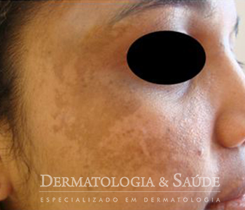 O Melasma aparece com frequência durante a gestação