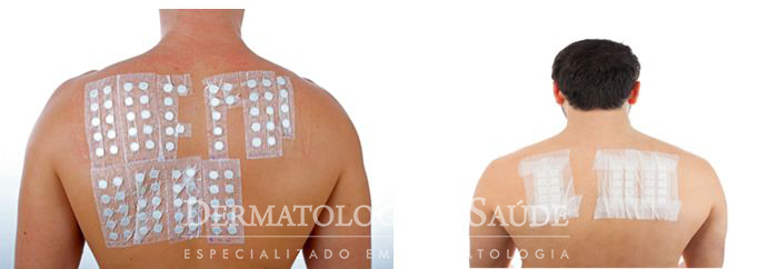 teste-de-contato-dermatologia-e-saude-3