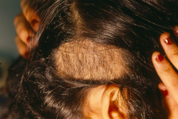 tricotilomania-dermatologia-e-saude (3)