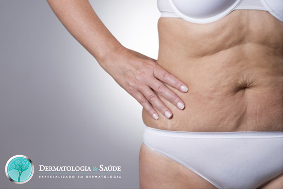 Mulher com pele do abdômen flácida (Foto: Dollar Photo Club)