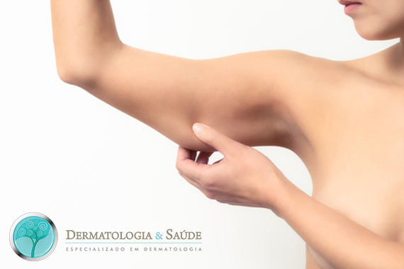 Mulher com pele do braço flácida (Foto: Dollar Photo Club)