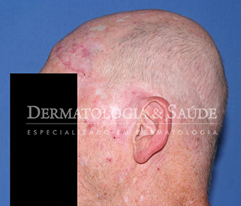 várias lesões de ceratoses actínicas