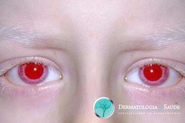 Os albinos possuem olhos azuis ou castanhos muito claros, às vezes, dão uma falsa impressão de serem vermelhos ou rosados