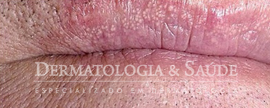 O tratamento dos grânulos de Fordyce tem bons resultados