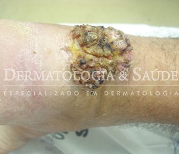 Voces-conhecem-a-Cromoblastomicose-dermatologia-e-saude-1