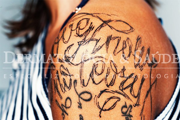 Muitas alternativas são propostas para retirada de tatuagens indesejadas. Alguns cremes são anunciados como milagrosos, porém o laser Q- switched ainda é a melhor opção.