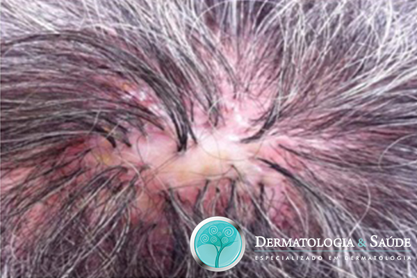 Foliculite Decalvante