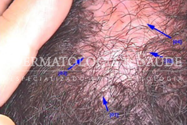 Foto 1 - A Foliculite Decalvante aparece como vermelhidão, crostas e bolinhas vermelhas na raiz dos cabelos.