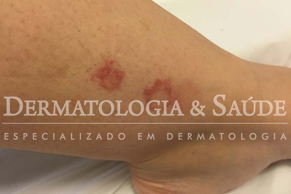 manchas-vermelhas-nas-pernas-o-que-pode-ser-dermatologia-e-saude-1