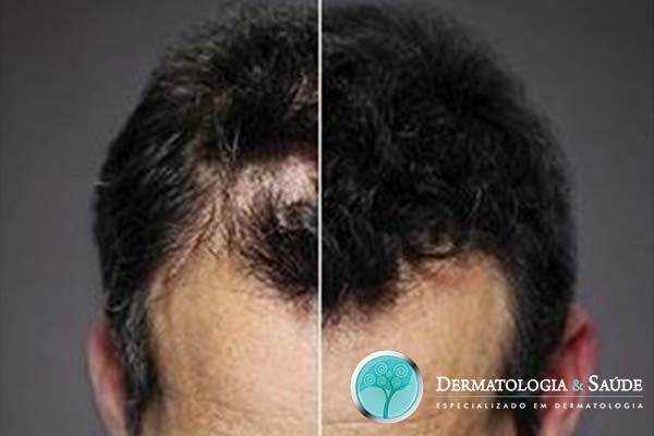 perdi-meus-cabelos-e-agora-dermatologia-e-saude-5