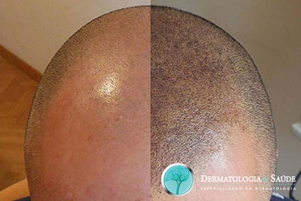 perdi-meus-cabelos-e-agora-dermatologia-e-saude-6